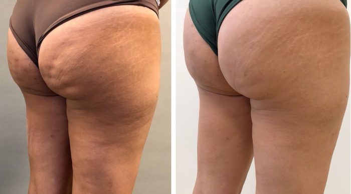 Esther S Cellulite Is Weg Dankzij Cellfina Ongelofelijk