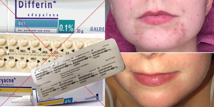 diepgaand regio Melodieus Verhaal: Fabienne kreeg Roaccutane tegen haar zware acne